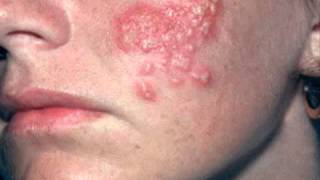 Atlanta Anonymous HERPES Testing 1-888-338-1082