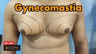 Gynaecomastia Problem In Men | Gynecomastia Surgery ( Man Boobs Reduction ) By Dr. Prashant Yadav