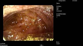 Corrosive acid poisoning - Endoscopy