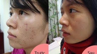 Kem Trị Mụn Owhite - Bí quyết Trị mụn tận gốc ngay tại nhà