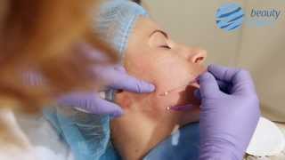 Мастер-класс по тредлифтингу мезонитями Lead Fine Lift Full Face от Елены Старковой Бьюти эксперт
