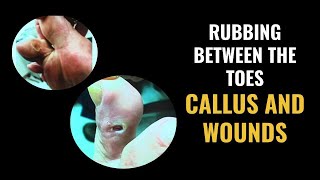 Rubbing Between The Toes - Calluses and Wounds