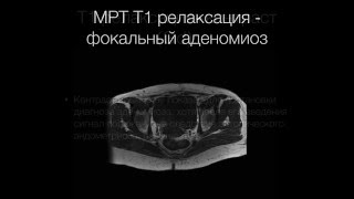 Radiology Study - Аденомиоз