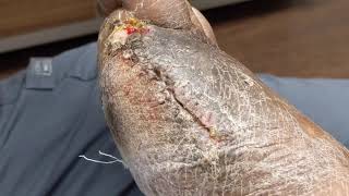 CASE UPDATE: THE GANGRENOUS TOE / PARTIAL FOOT AMPUTATION AND MAYBE ANOTHER ON THE WAY ????