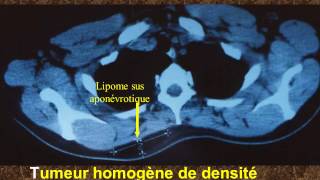 Intérêt du scanner dans le diagnostic préopératoire des tumeurs lipomateuses