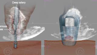 Penectomy