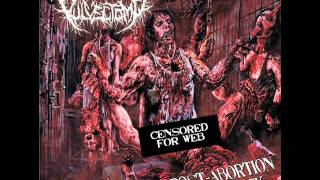 Vulvectomy - drowned in afterbirth
