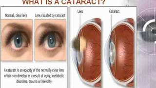NCLEX-MS NURSING REVIEW ON CATARACT