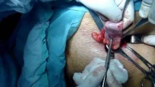 inguinal hernia repair