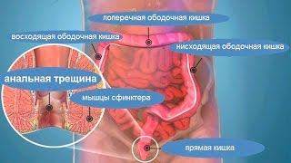 Анальная трещина - методы консервативного лечения!