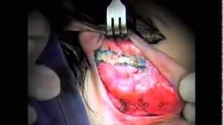 Otoplastia Completa para o Residente