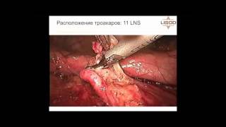 Лапароскопическая хирургия при местно распространенном раке желудка