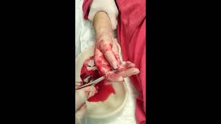 finger abscess.Treatment.панариций сухожильный.операция.