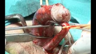 Ventral Penile Curvature