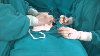 Multiple small swellings in balls testes - Sebaceous cyst in scrotum treatment