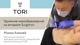 Удаление новообразований на аппарате Surgitron