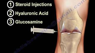 Knee pain ,arthritis and Injured Cartilage - Everything You Need To Know - Dr. Nabil Ebraheim, M.D.