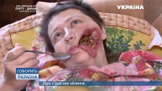Дыра съедает мое лицо (полный выпуск) | Говорить Україна