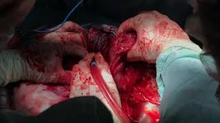 Врастание плаценты.Placenta percreta.