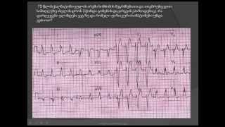 ეკგ/ აორტული სარქვლის სტენოზი (აორტული სტენოზი, აორტული მანკი, აორტის სარქვლის სტენოზი)
