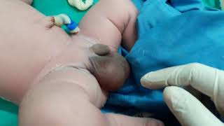 Big testis or hydrocele
