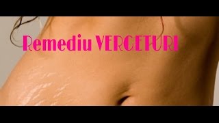 Remediu Anti-VERGETURI!!! Previne, atenueaza si elimina vergeturile...