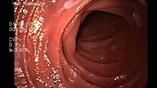 Endoscopia Post Bypass gástrico