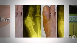 valgus plus купить в екатеринбурге

  -  Дефект ”шишек” на ноге??