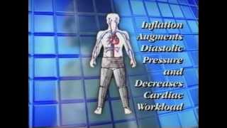 CardiAssist™ External Counter Pulsation (ECP) System