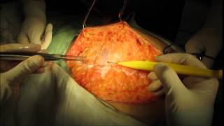 Hernia Gigante