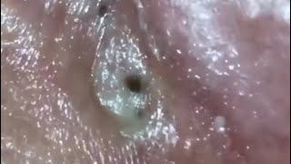 Big Blackheads!
