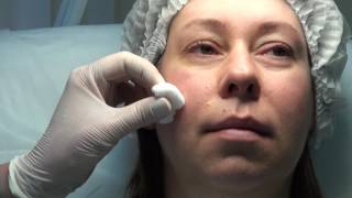 Коррекция скул и подбородка Princess Filler