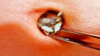 Popping Navel Stones & Belly Blackheads
