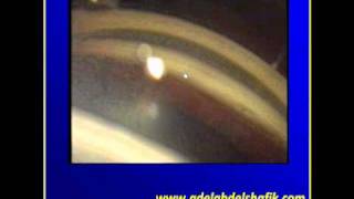 Gonioscopy Lecture part 3