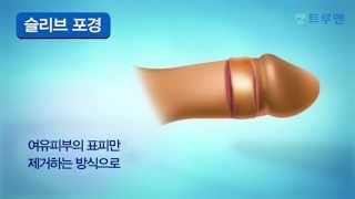 일반포경수술과 특수포경수술 종류 및 방법 - 트루맨남성의원