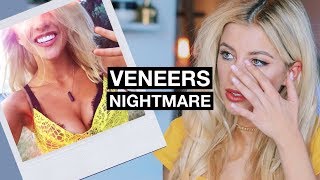My Horrific Experience With Veneers | The Truth