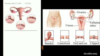 ANATOMY OF THE UTERUS AND FEMALE STERILIZATION | The White Army