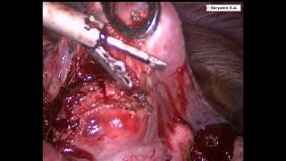 Торакоскопическоей удаление метастаза легкого. Thoracoscopic enucleation of lung metastases.