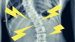 *SCOLIOSIS* (BACK PAIN, HEADACHE) RELIEF
