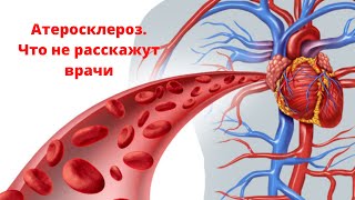Атеросклероз.  То,что вам не расскажут врачи  Холестерин, часть 3