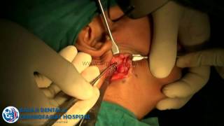 FACIAL ASYMMETRY HEMIFACIAL MICROSOMIA GROWTH CENTRE TRANSPLANTATION - DR SM BALAJI