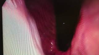 Endoscopia No Bypass Com Anel