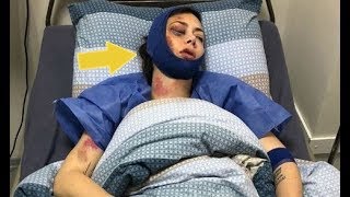 Жестокое избиение: актриса Самбурская показала свое изуродованное лицо