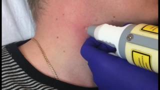 Удаление кожных новообразований в Laser Clinic