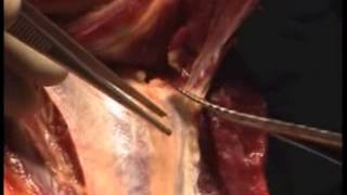 extended posterior flap technique for transtibial amputation