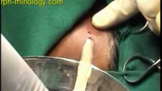 Neck Space Infections