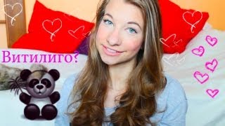♥Витилиго♥ (моя история)