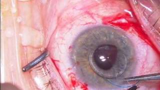Scleral Fixation via haptic externalization by Steven G. Safran MD