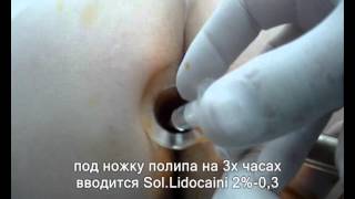 полипэктомия