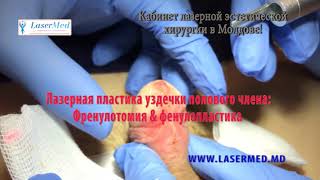 Лазерная френулотомия пластика уздечки& френулопластика в Молдове  Кишиневе !